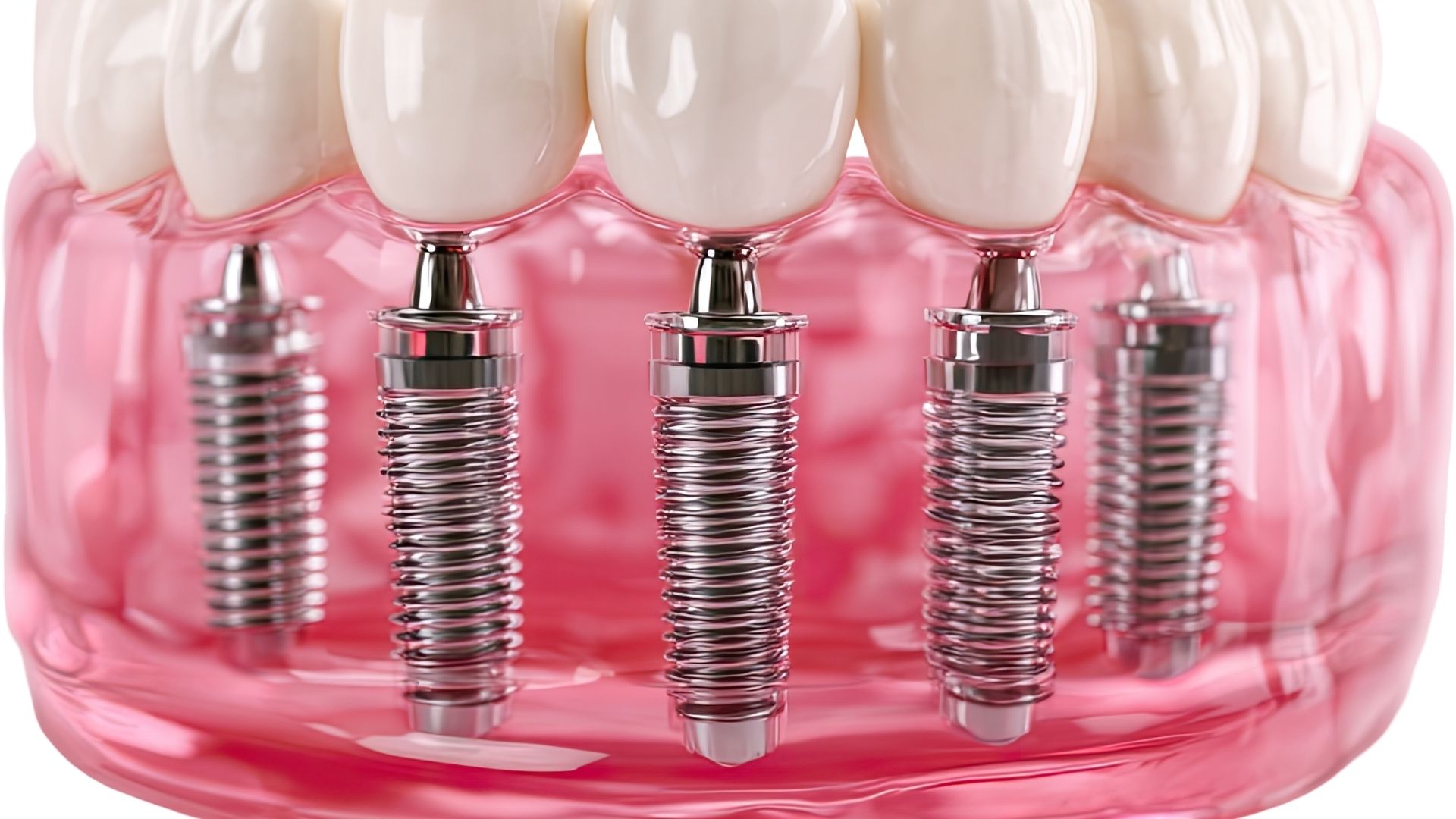 Dental implant model showing implant placement procedure