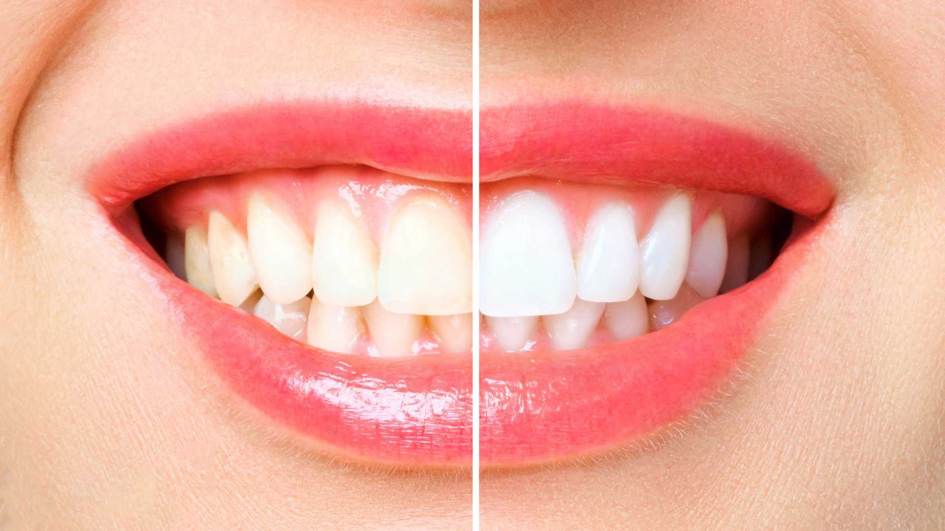 Bright white smile achieved through professional teeth whitening